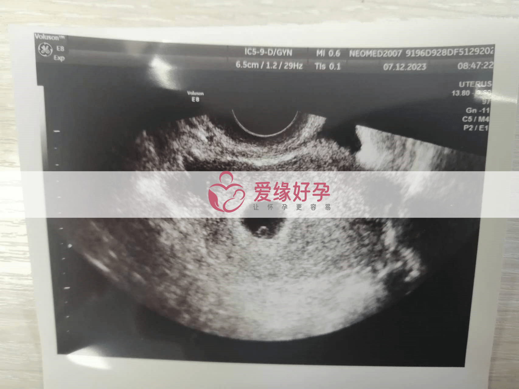 乌克兰代孕代孕代母5周产检顺利通过！