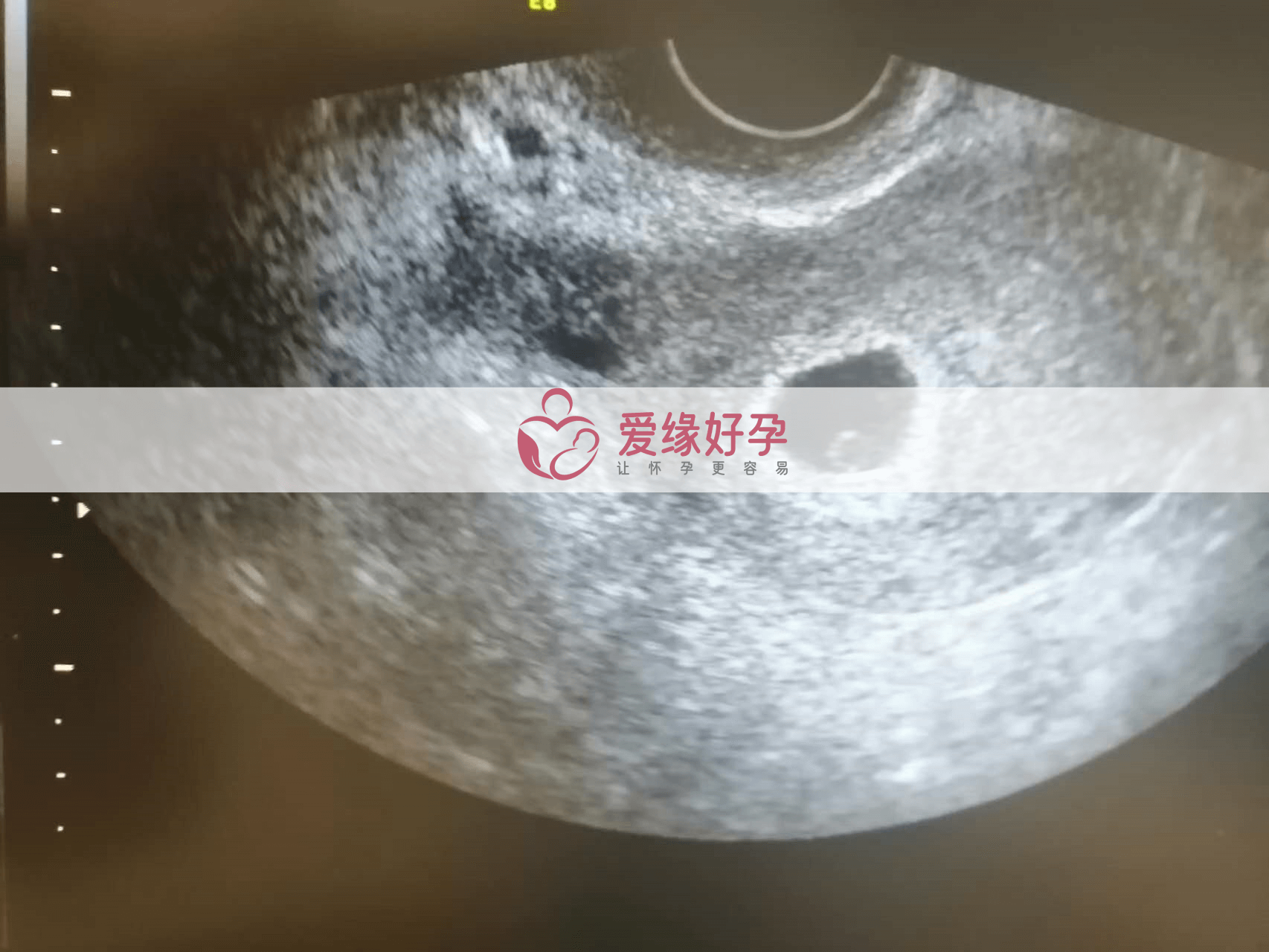 乌克兰代孕代孕代母5周产检顺利通过！