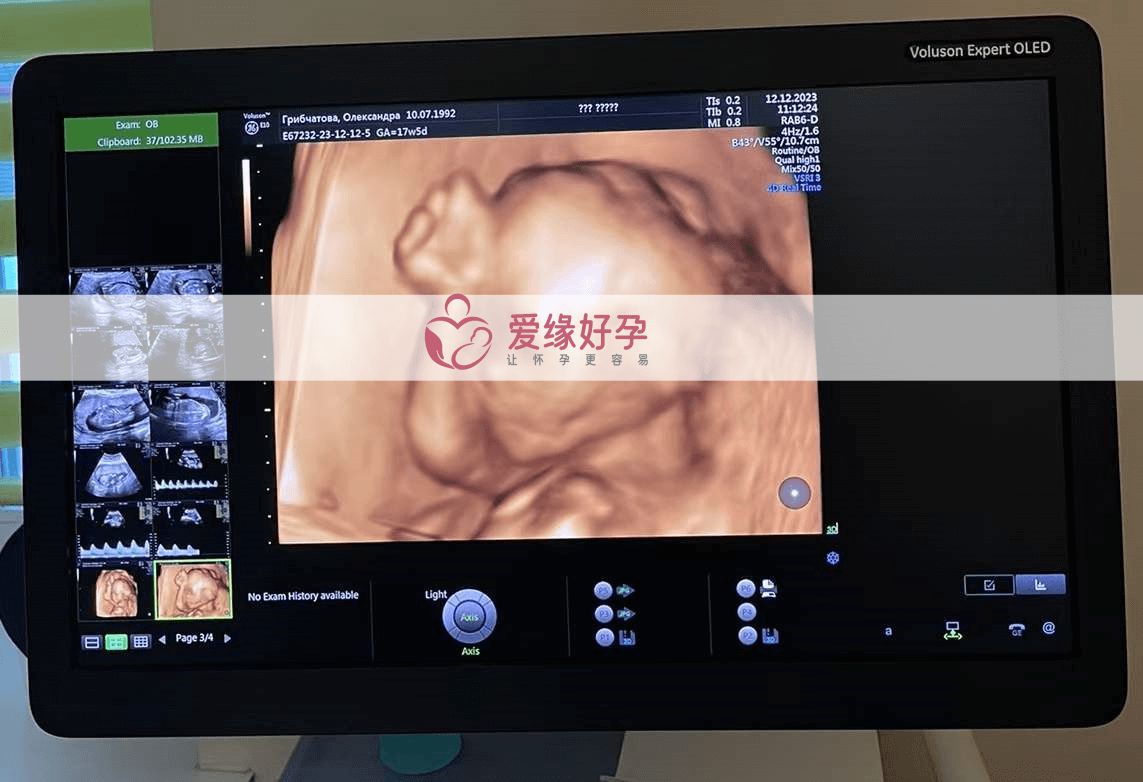 乌克兰试管婴儿代孕代母孕18周产检顺利通过