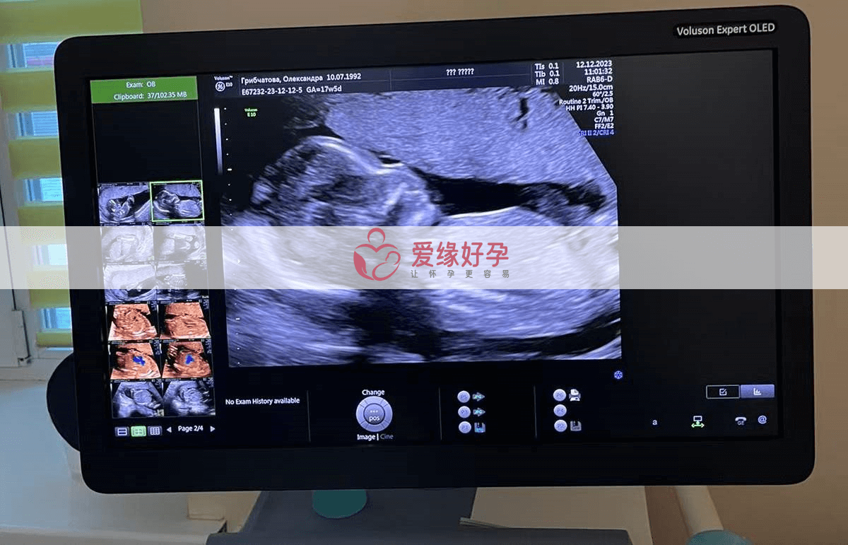 乌克兰试管婴儿代孕代母孕18周产检顺利通过