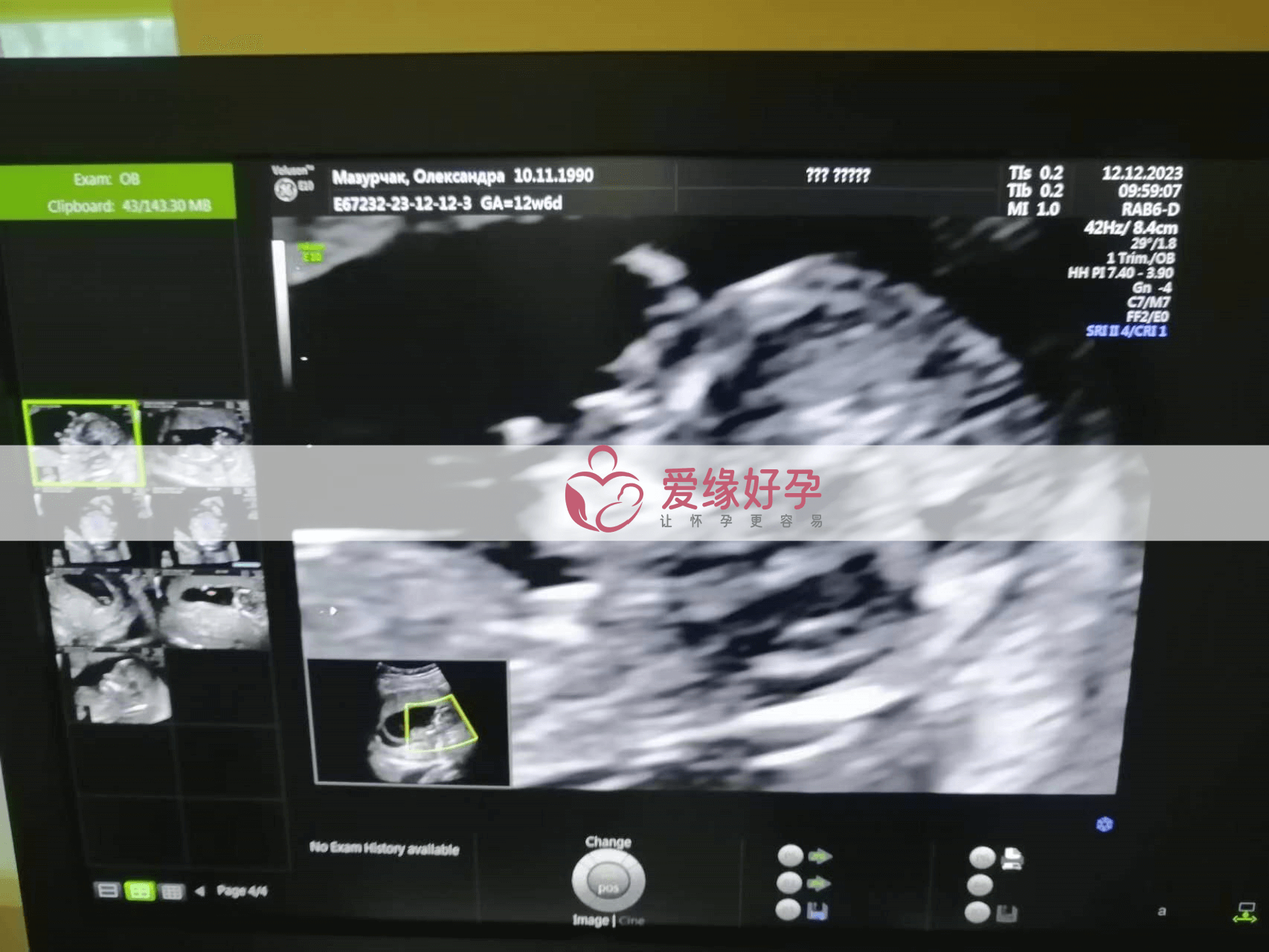 乌克兰代孕代孕代母12周孕检NT通过