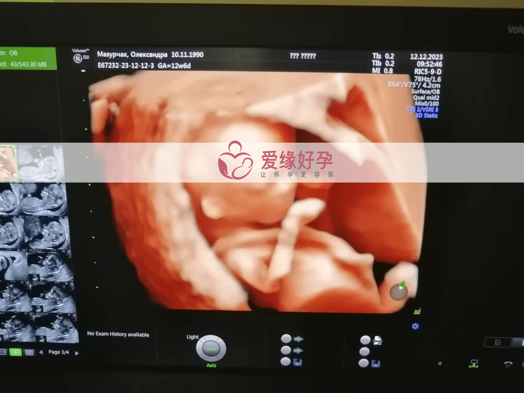 乌克兰代孕代孕代母12周孕检NT通过