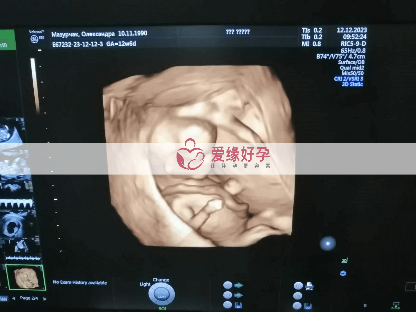 乌克兰代孕代孕代母12周孕检NT通过