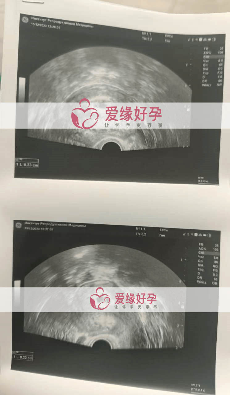 哈萨克斯坦代孕孕母第一次B超孕检通过！