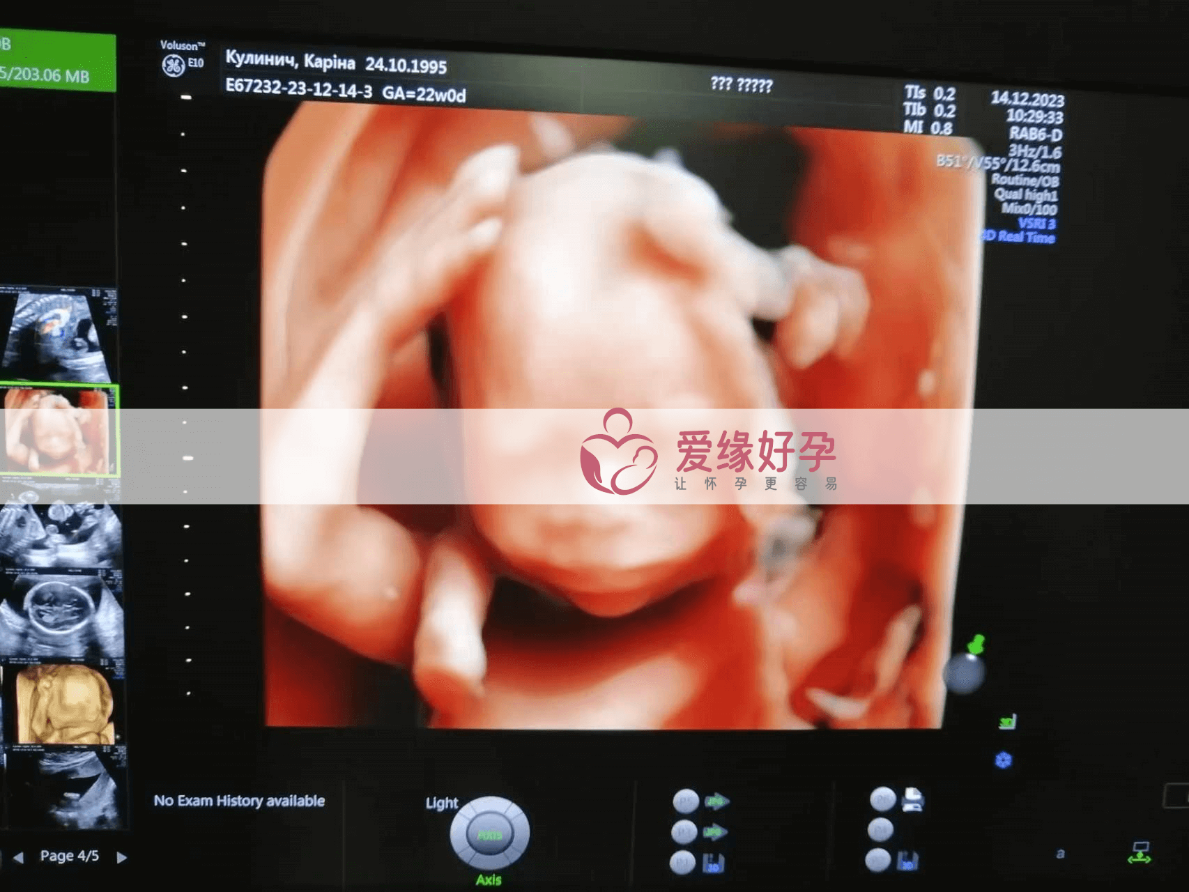 乌克兰代孕代孕代母20周产检顺利通过！