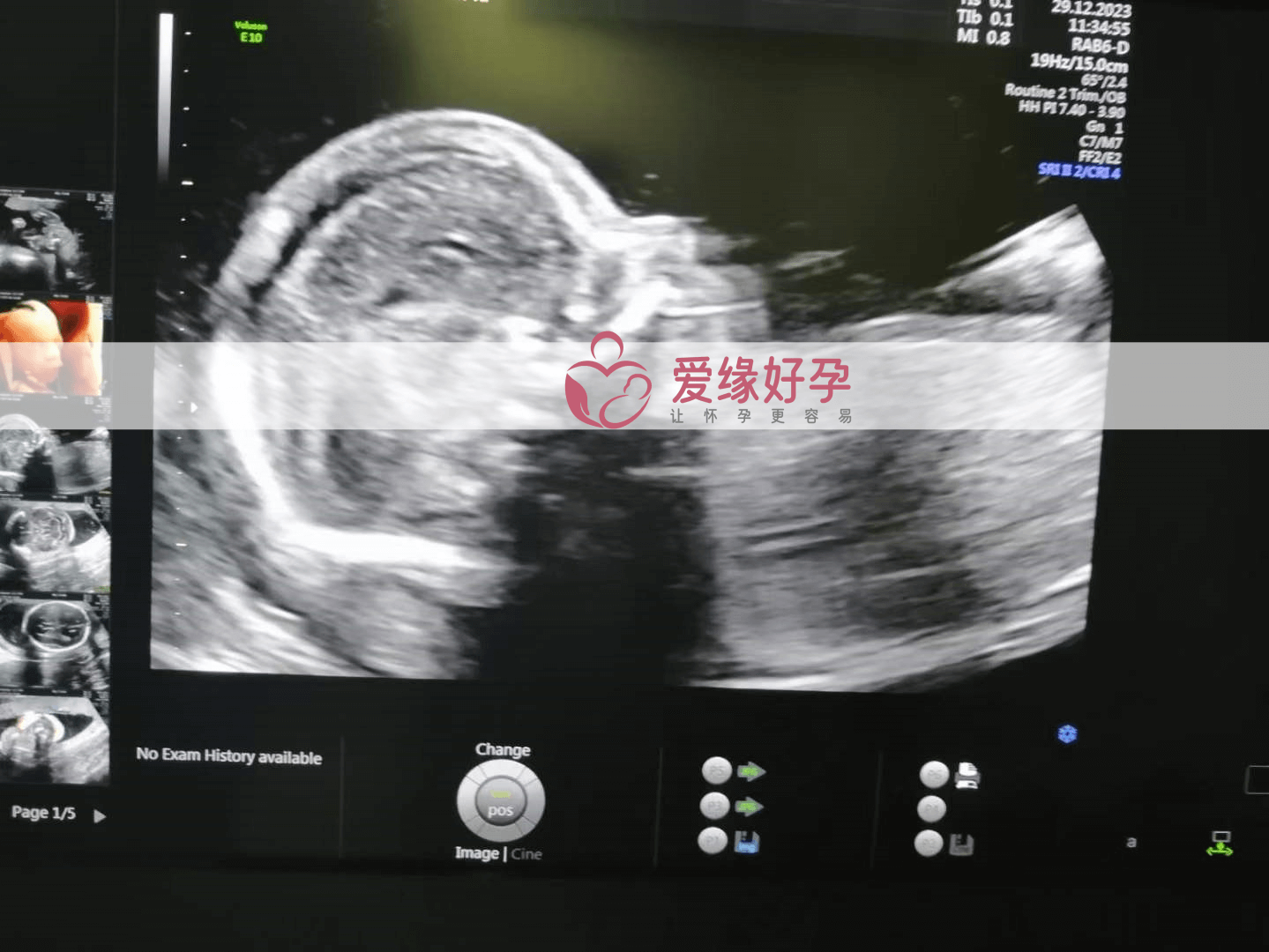 爱缘好孕:代孕代孕代母21周产检顺利通过