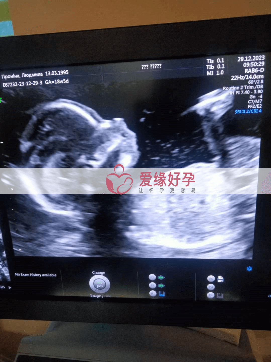爱缘好孕:代孕代孕代母18周产检顺利通过