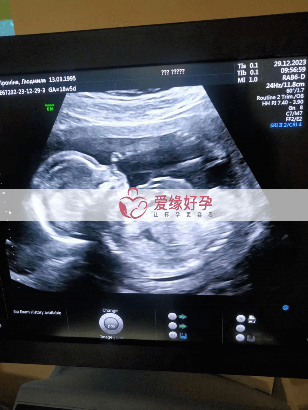 爱缘好孕:代孕代孕代母18周产检顺利通过