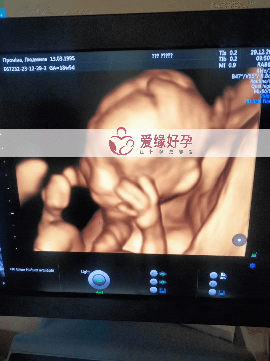 爱缘好孕:代孕代孕代母18周产检顺利通过