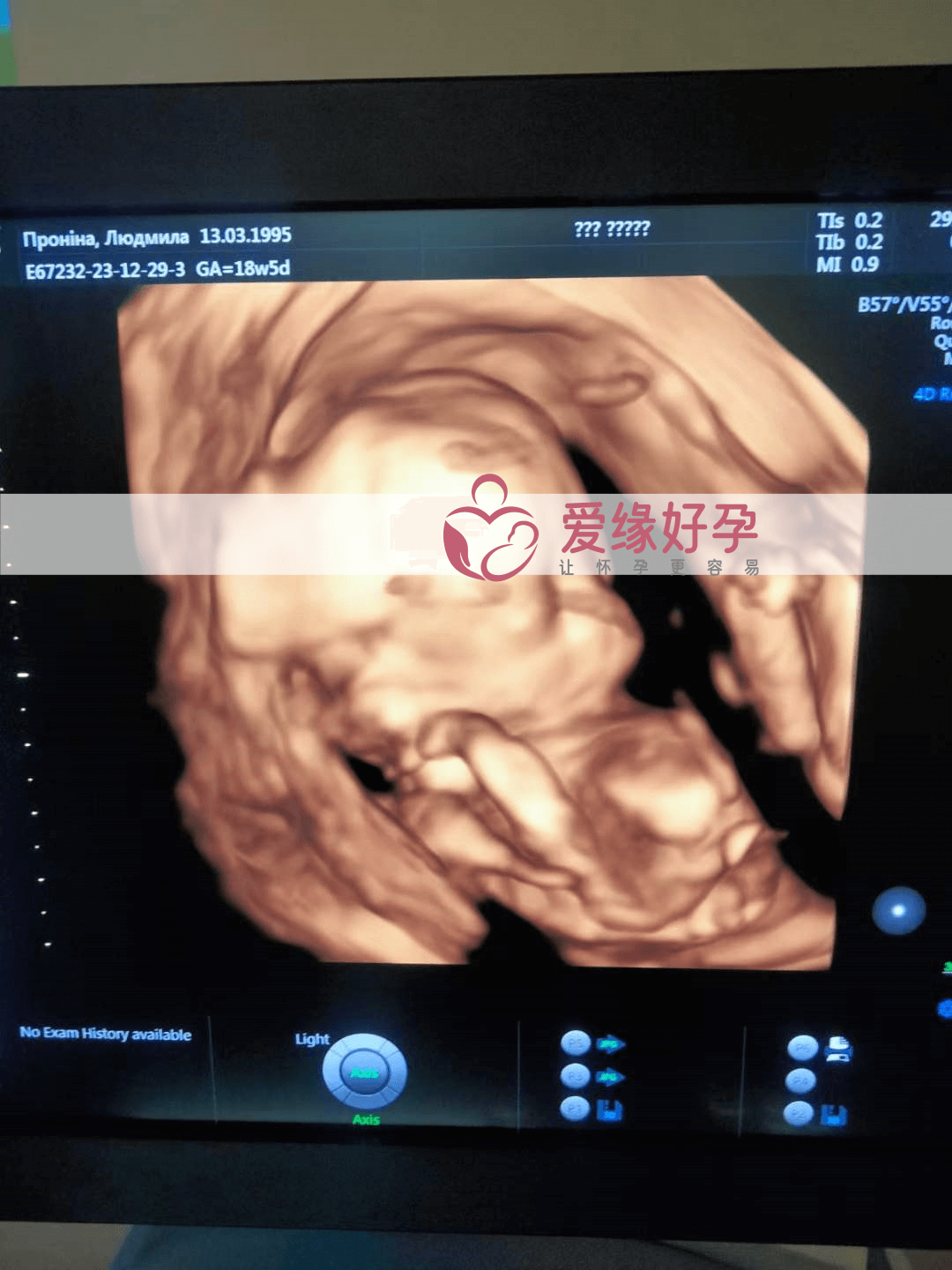 爱缘好孕:代孕代孕代母18周产检顺利通过