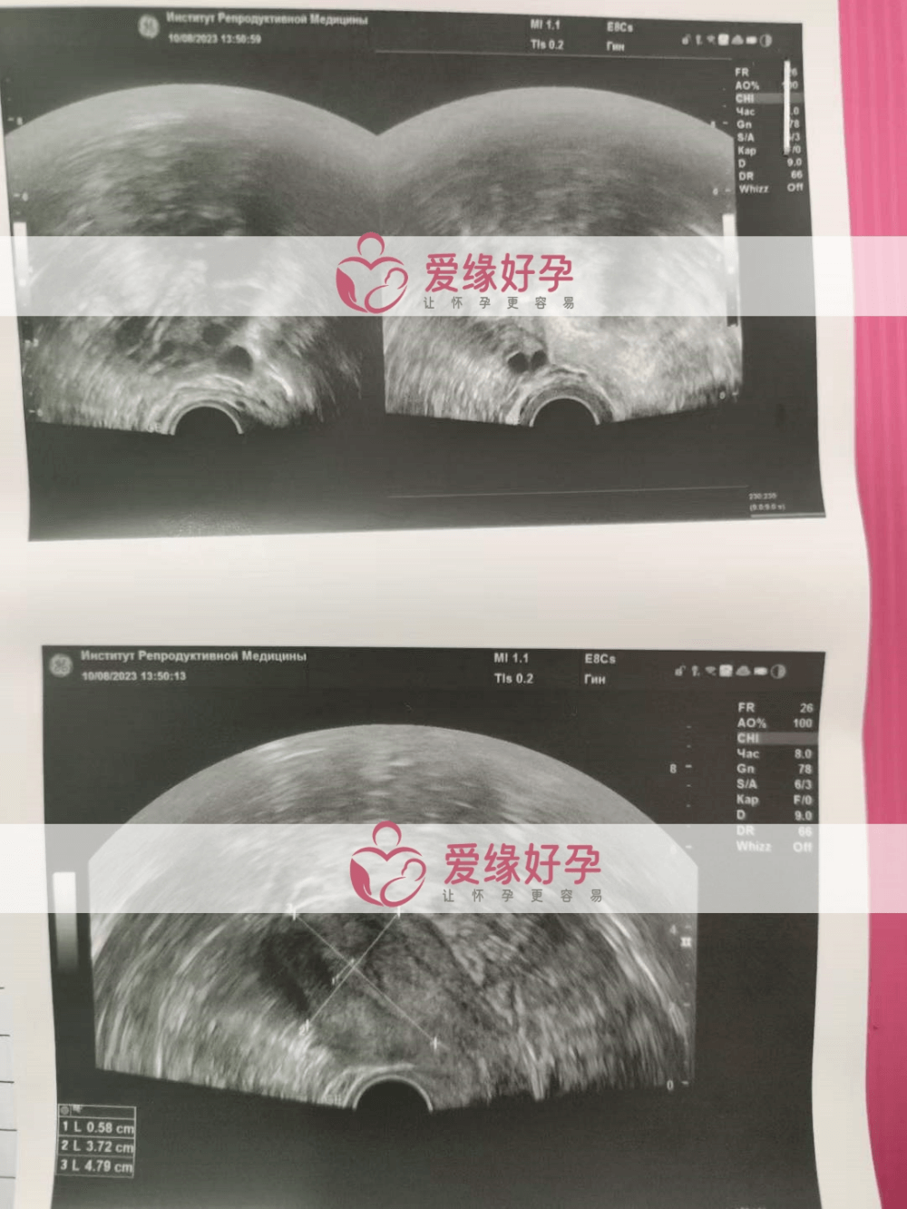 爱缘好孕哈萨克斯坦代孕委托父母就诊