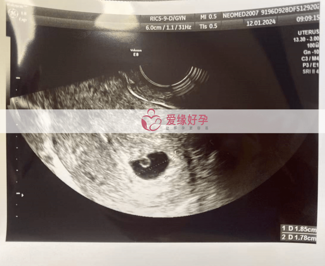 爱缘好孕哈萨克斯坦代孕5周孕检通过