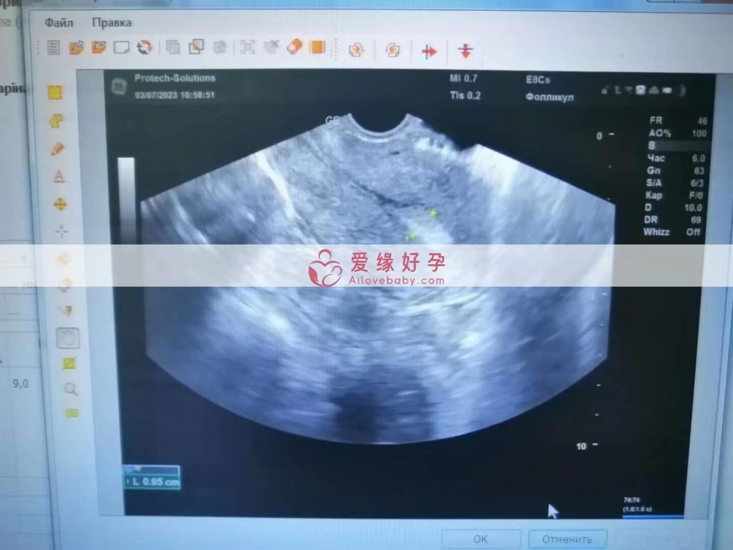 爱缘好孕哈萨克斯坦代孕内膜监测顺利通过