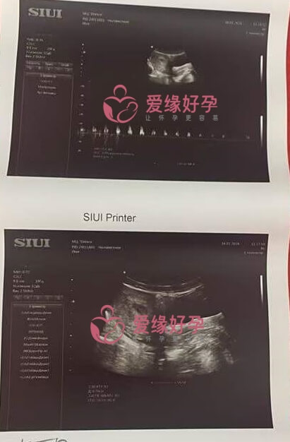 哈萨克斯坦代孕第一次B超检查通过