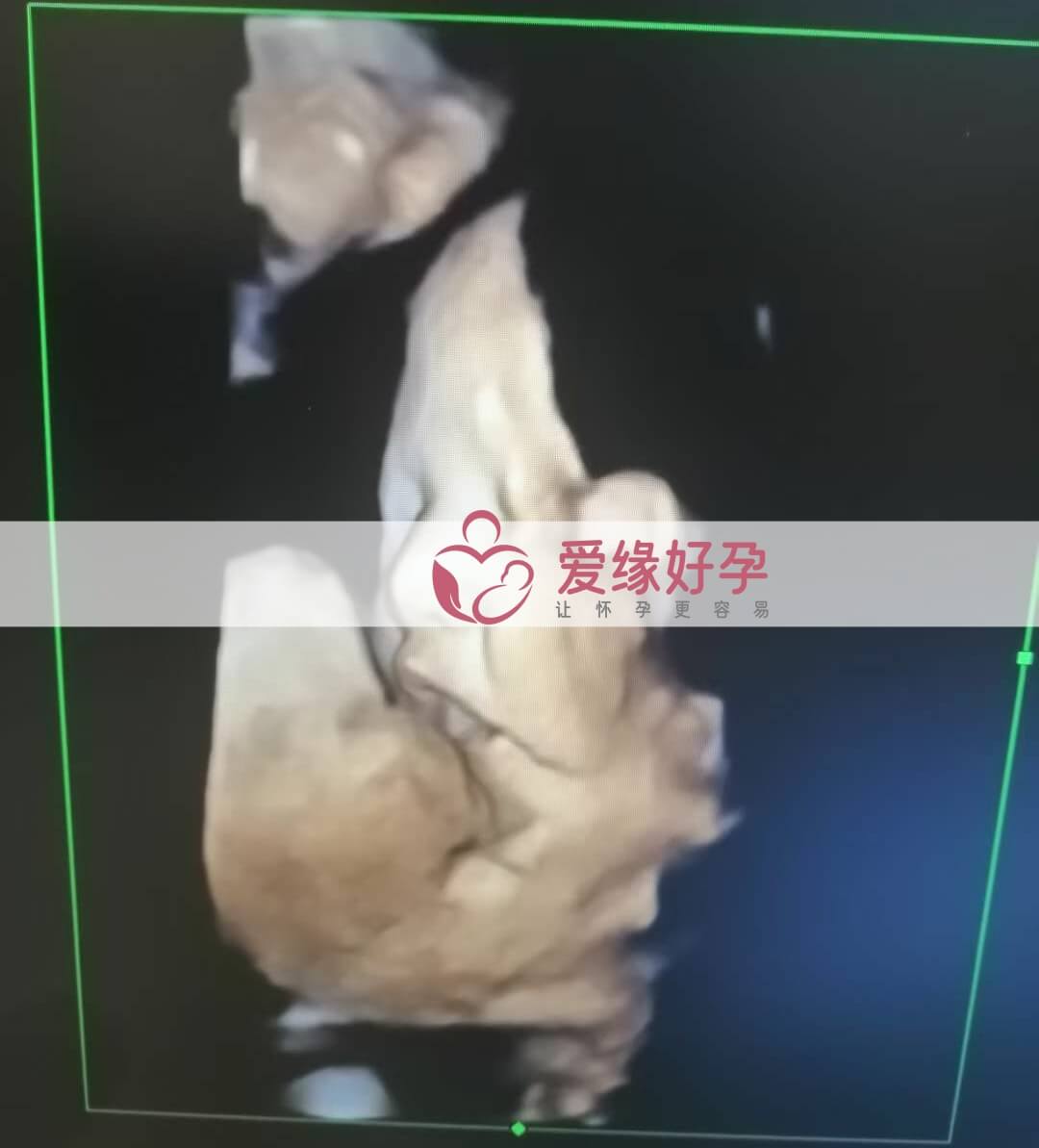 哈萨克斯坦试管婴儿助代母妈35周产检顺利通过