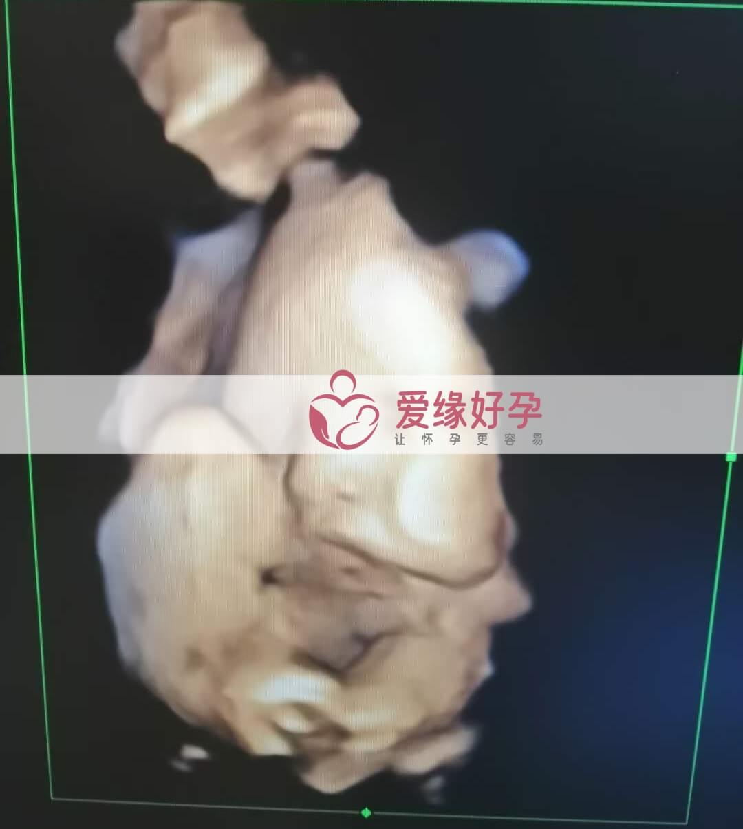 哈萨克斯坦试管婴儿助代母妈35周产检顺利通过