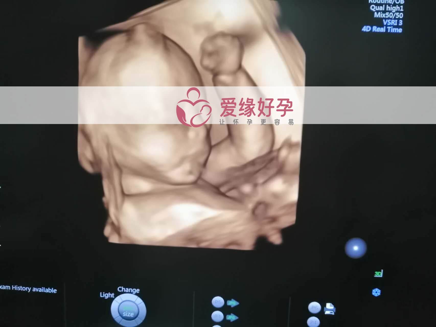 哈萨克斯坦试管婴儿助代母妈23周产检顺利通过