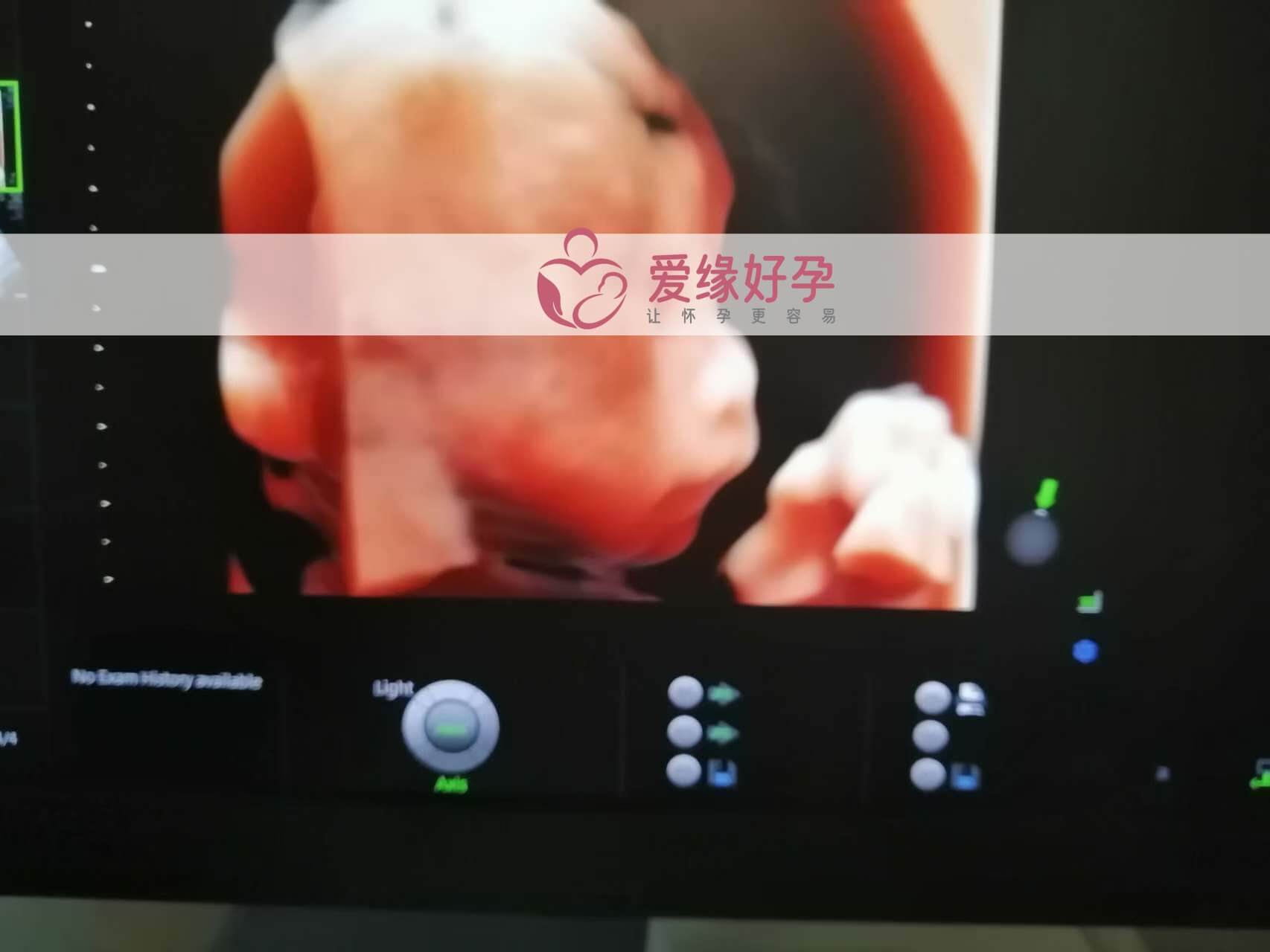 哈萨克斯坦试管婴儿助代母妈23周产检顺利通过