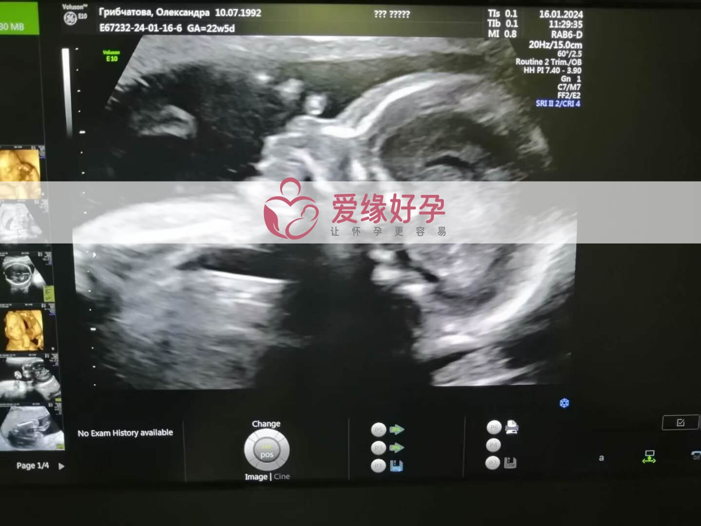 哈萨克斯坦试管婴儿助代母妈23周产检顺利通过