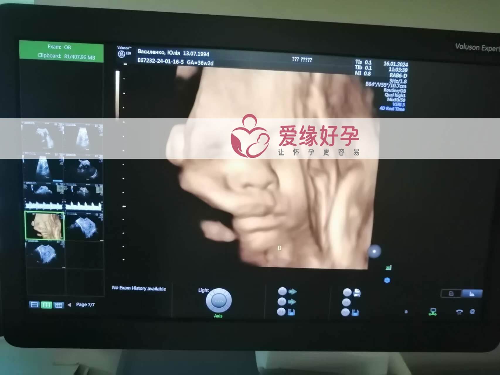 哈萨克斯坦试管婴儿助代母妈34周产检通过