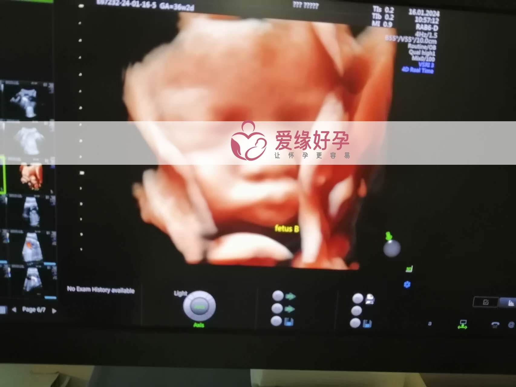 哈萨克斯坦试管婴儿助代母妈34周产检通过