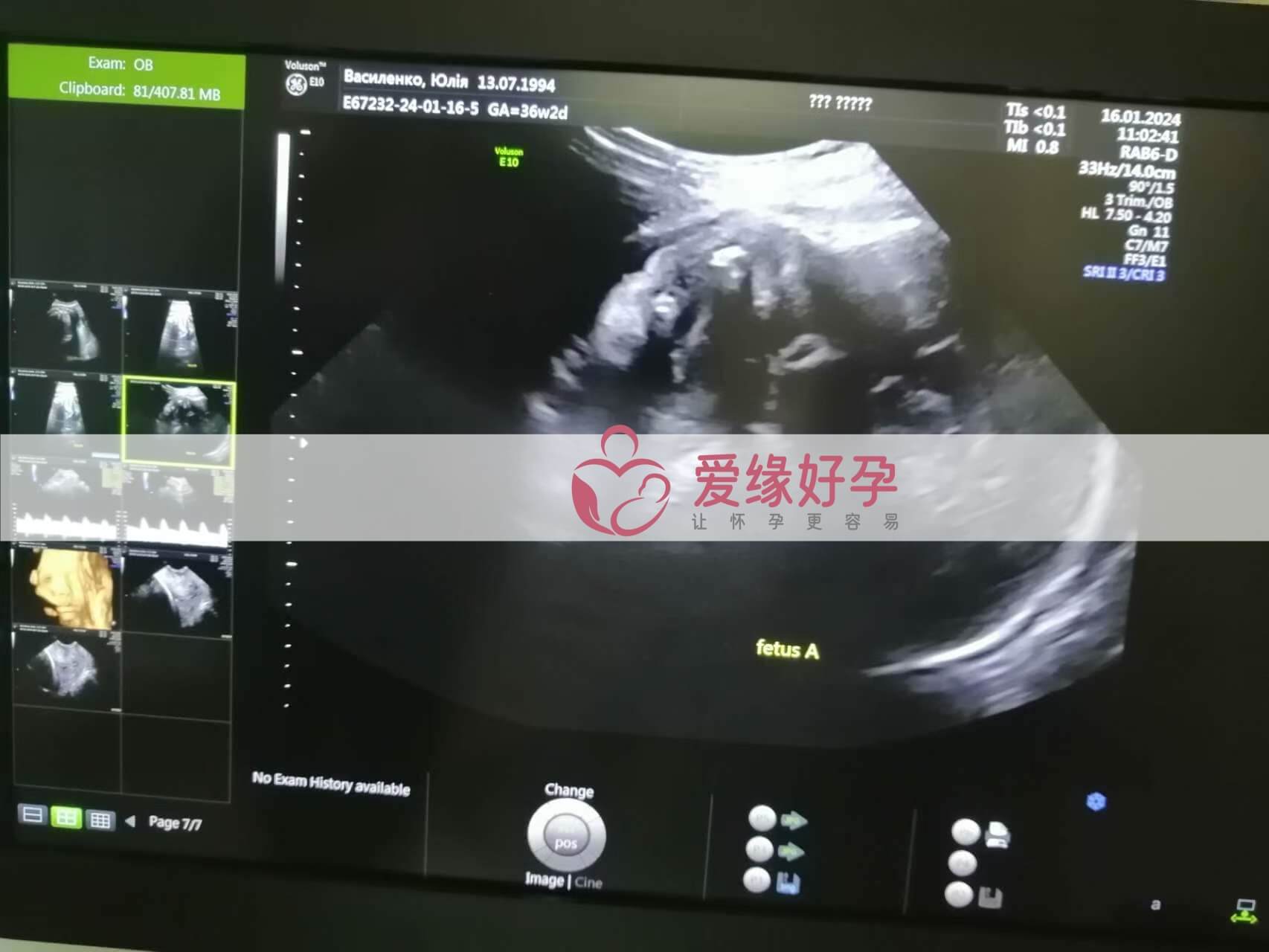 哈萨克斯坦试管婴儿助代母妈34周产检通过