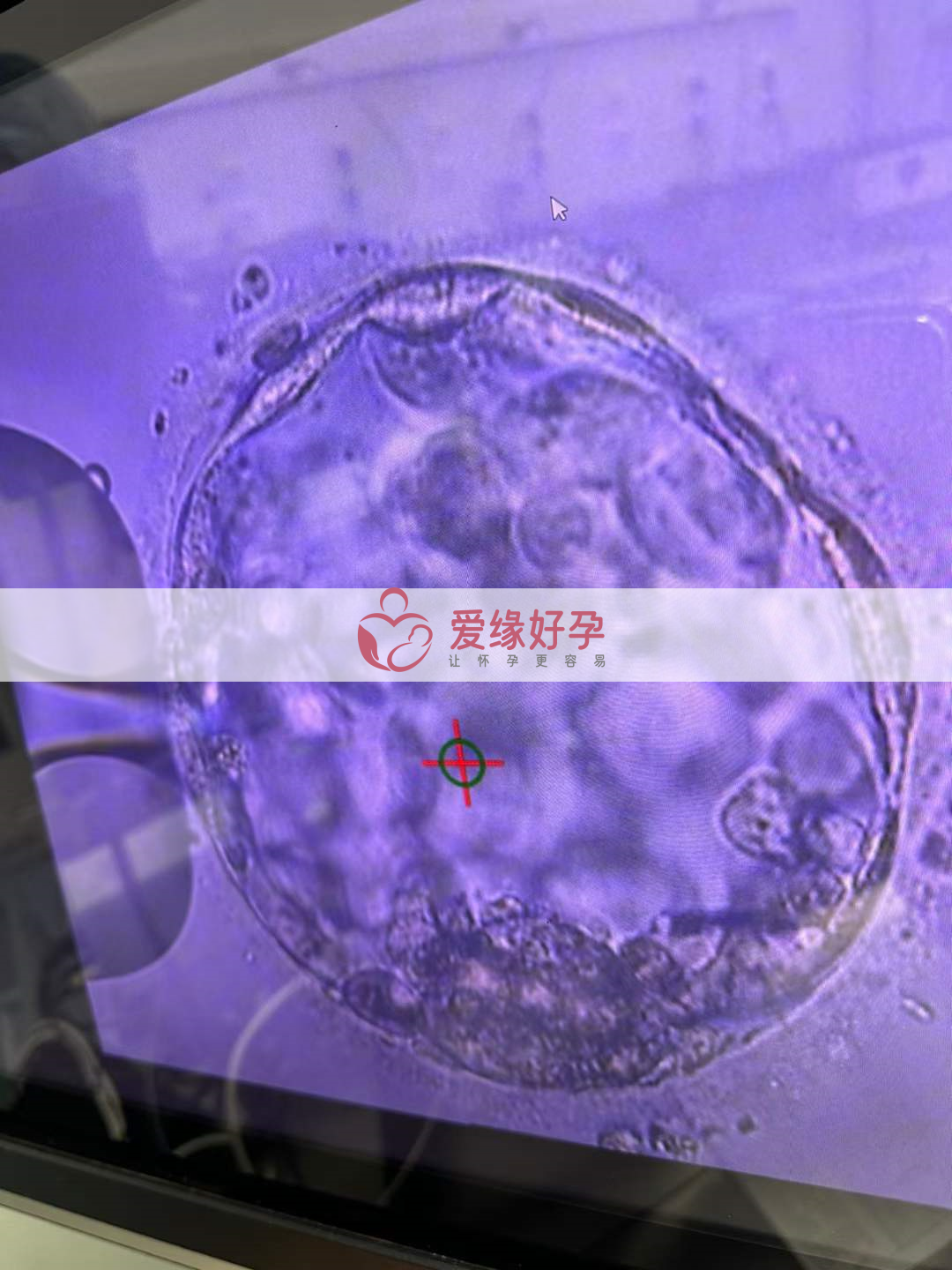 哈萨克斯坦代孕代孕代母顺利移植一颗囊胚