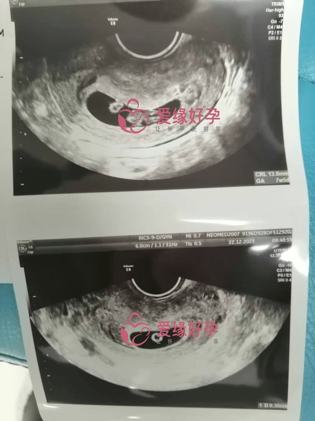 乌克兰代孕代孕代母7周产检顺利通过