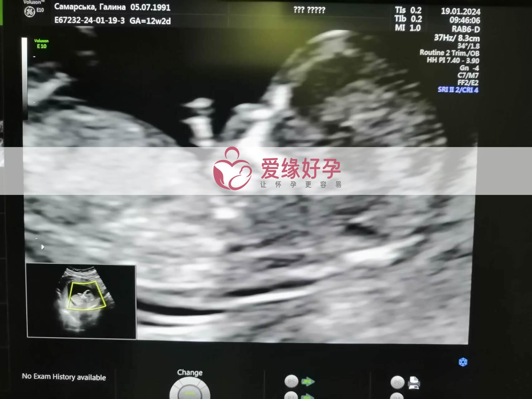 哈萨克斯坦试管婴儿助代母妈12周产检通过