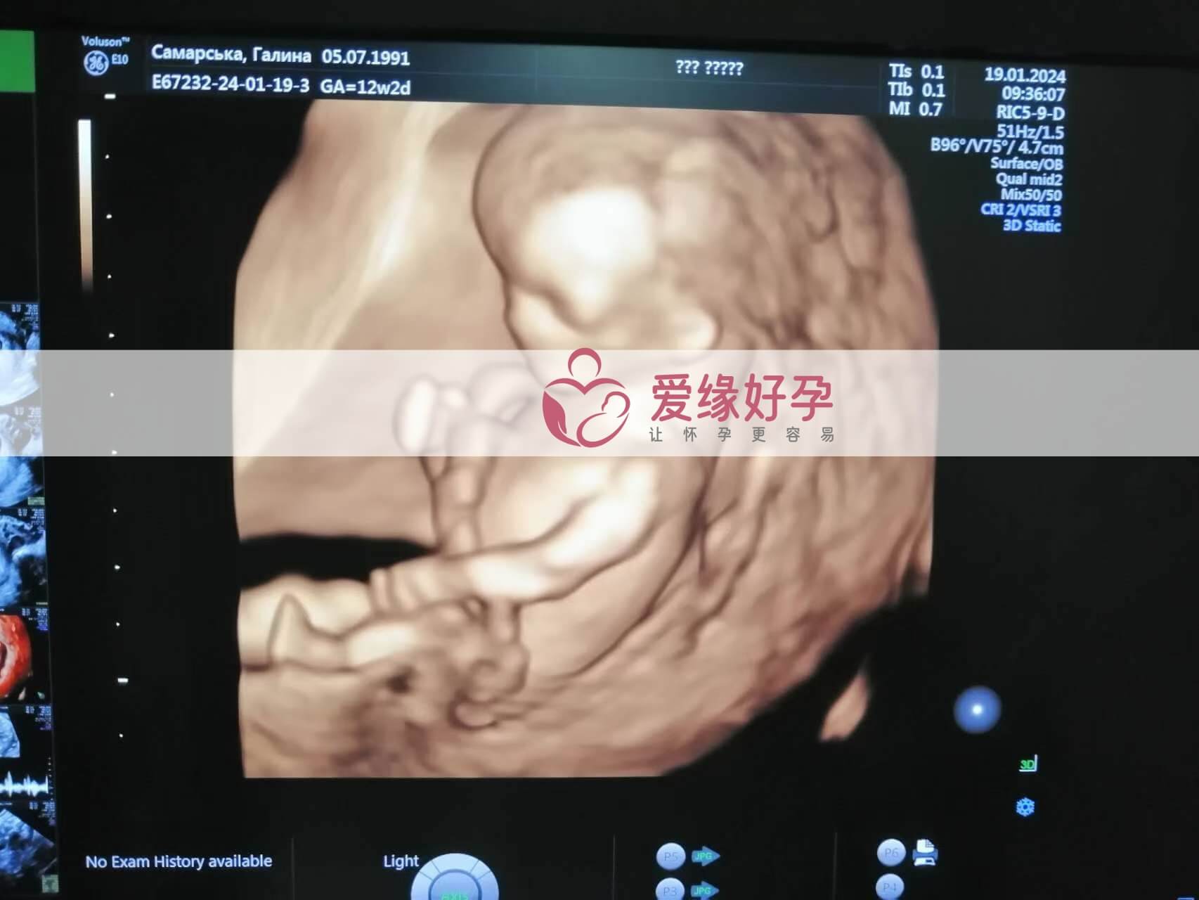 哈萨克斯坦试管婴儿助代母妈12周产检通过