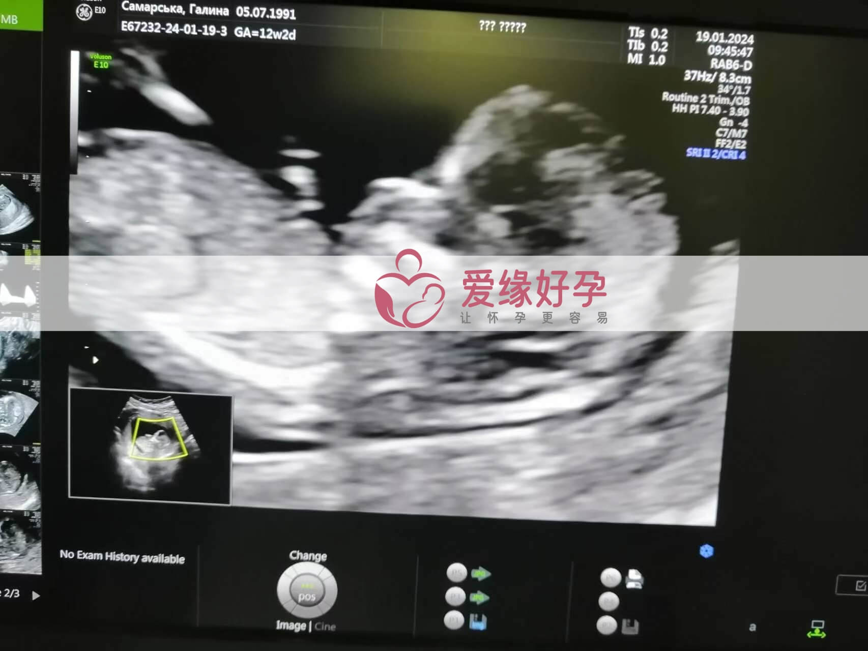 哈萨克斯坦试管婴儿助代母妈12周产检通过