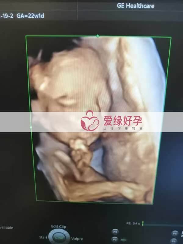 哈萨克斯坦试管婴儿助代母妈22周产检通过