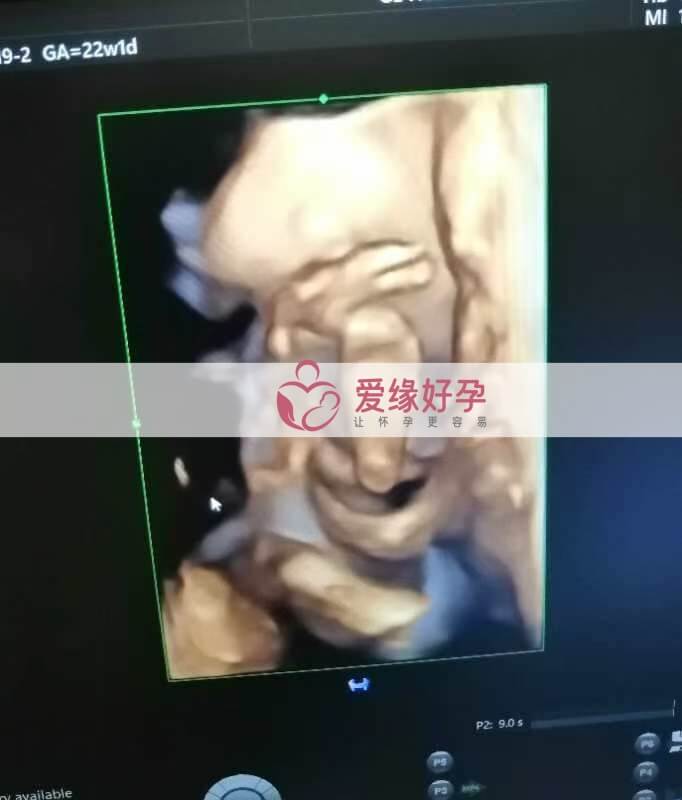 哈萨克斯坦试管婴儿助代母妈22周产检通过