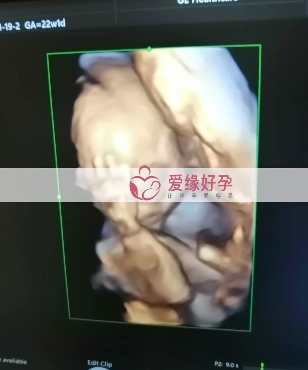 哈萨克斯坦试管婴儿助代母妈22周产检通过