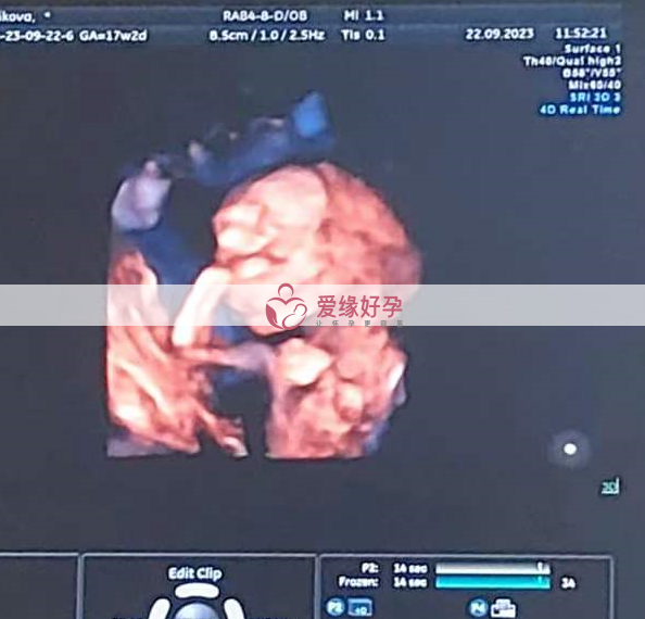 台湾委托父母同卵双胞胎17周检查顺利通过！