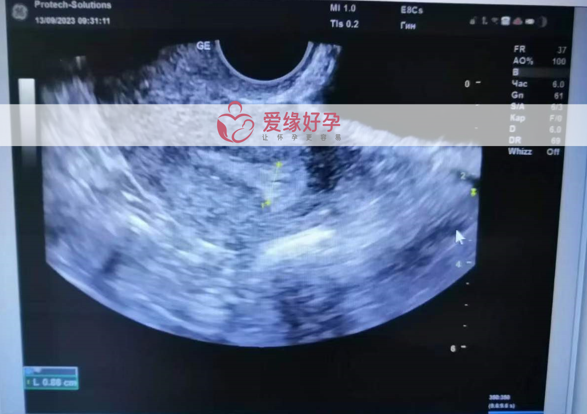 乌克兰哈萨克斯坦代孕代母移植一颗来自日本的囊胚！