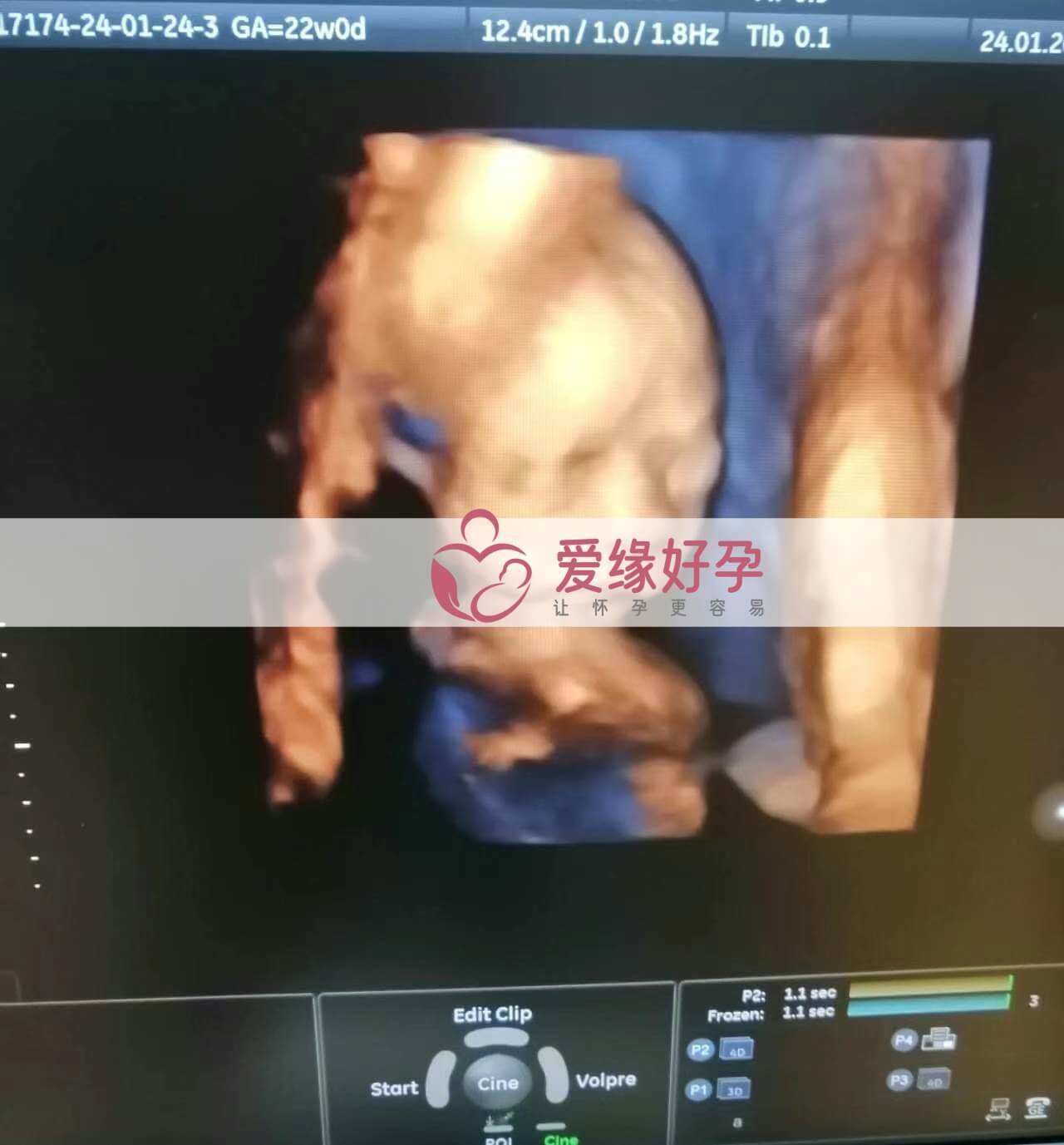 代孕代孕代母21周产检顺利通过