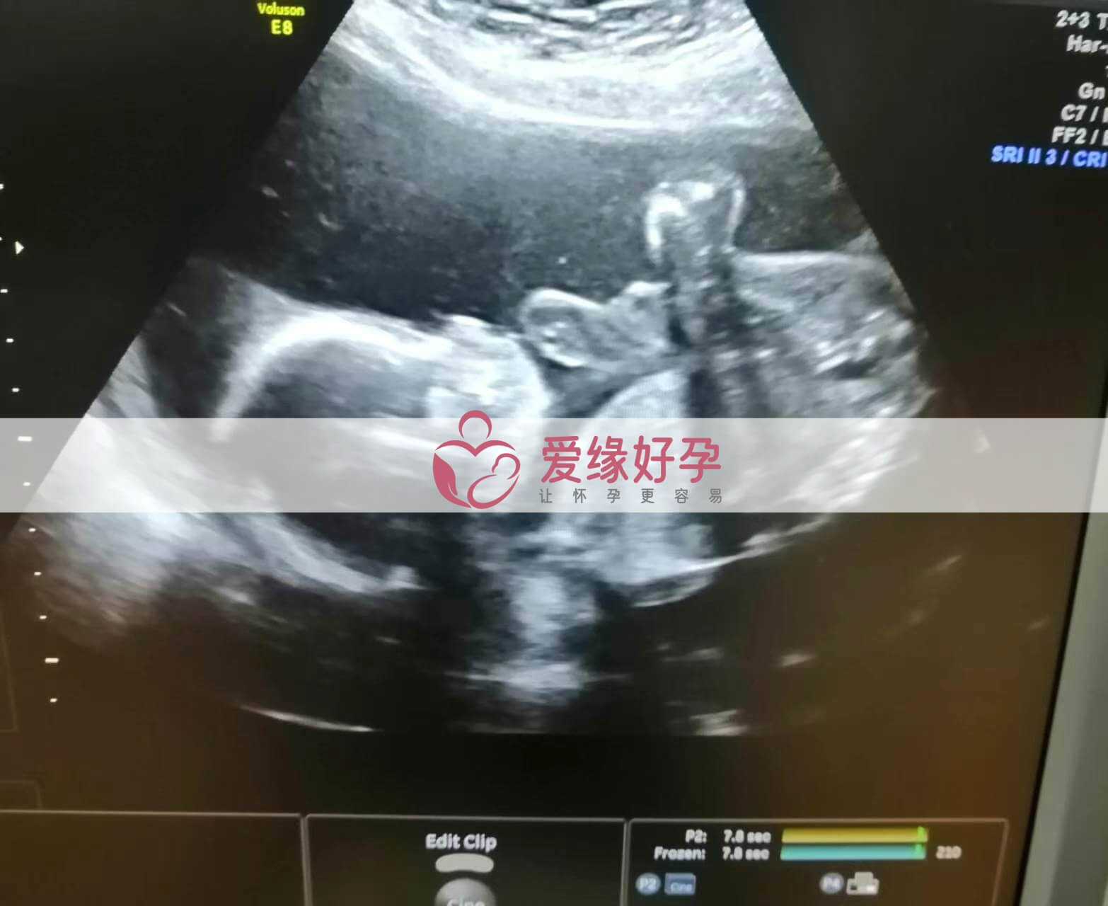 代孕代孕代母21周产检顺利通过
