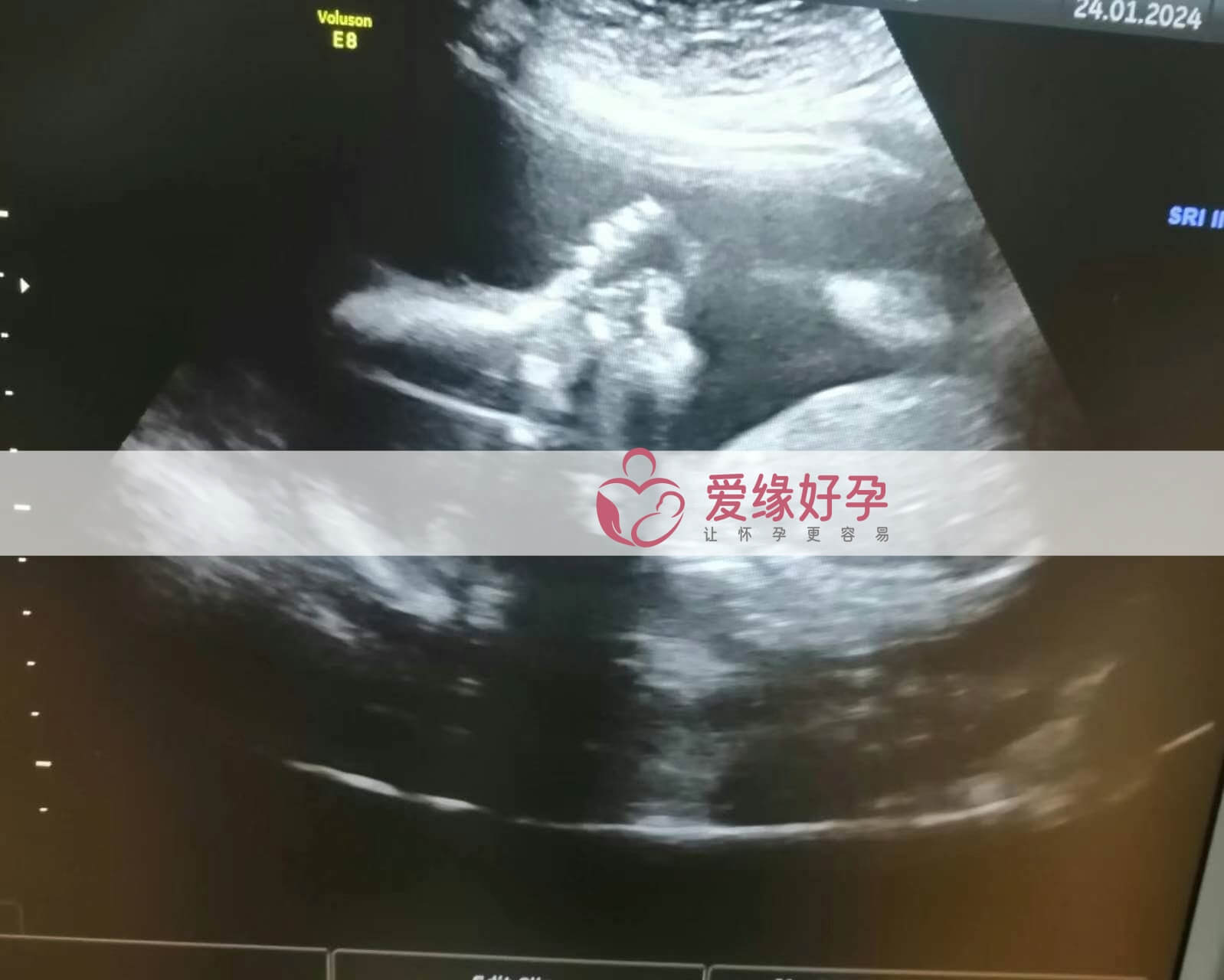 代孕代孕代母21周产检顺利通过