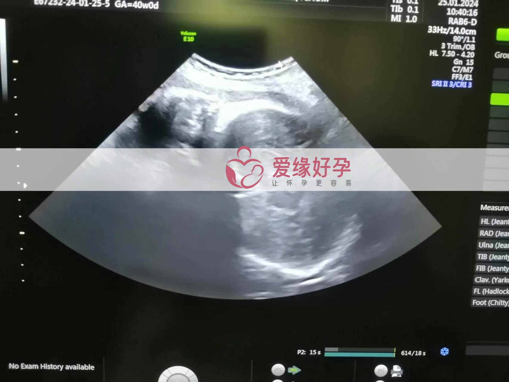代孕代孕代母39周产检顺利通过