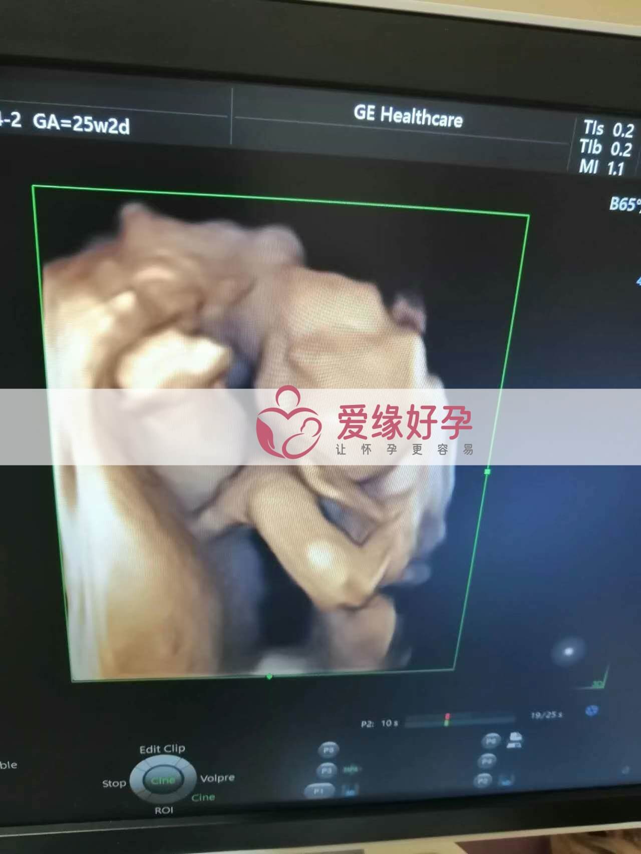 代孕代孕代母24周产检顺利通过