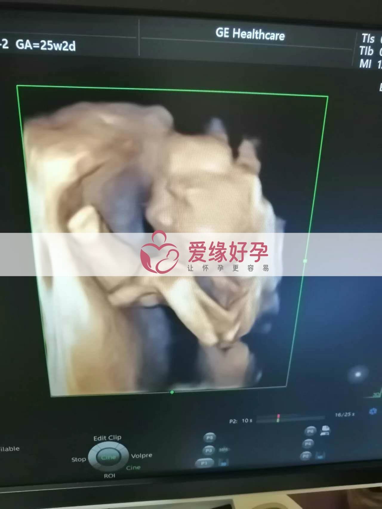 代孕代孕代母24周产检顺利通过