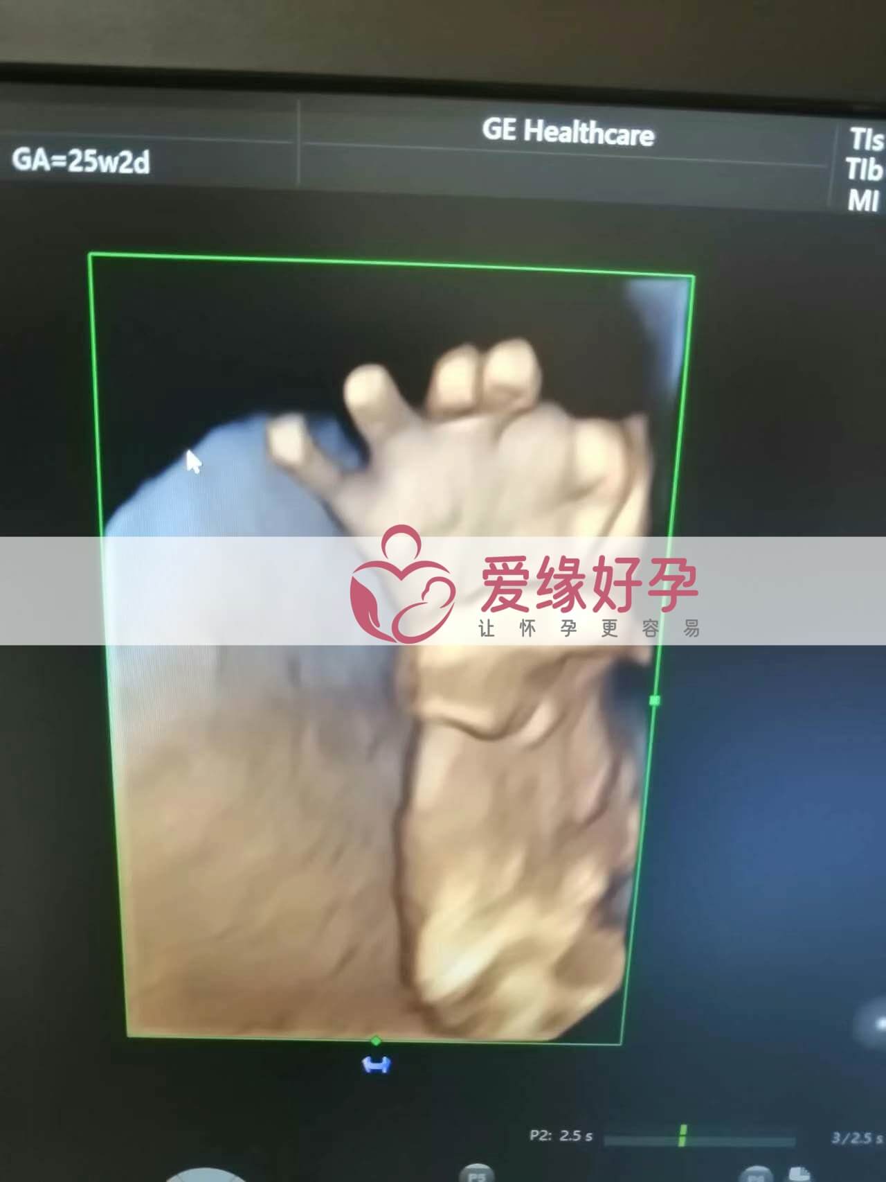 代孕代孕代母24周产检顺利通过