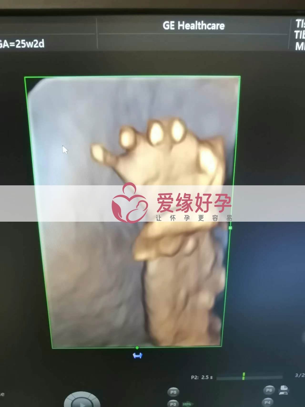 代孕代孕代母24周产检顺利通过