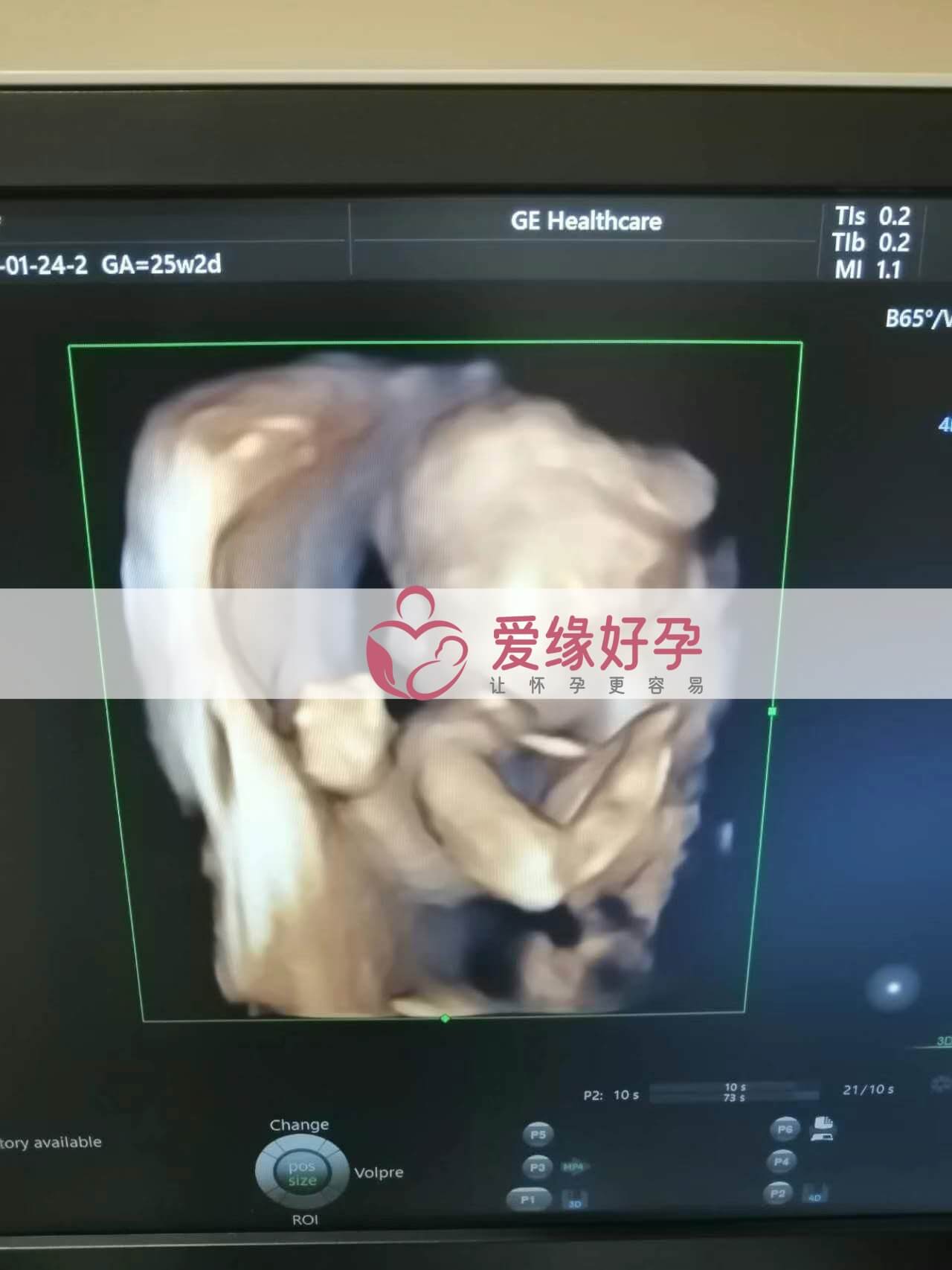 代孕代孕代母24周产检顺利通过