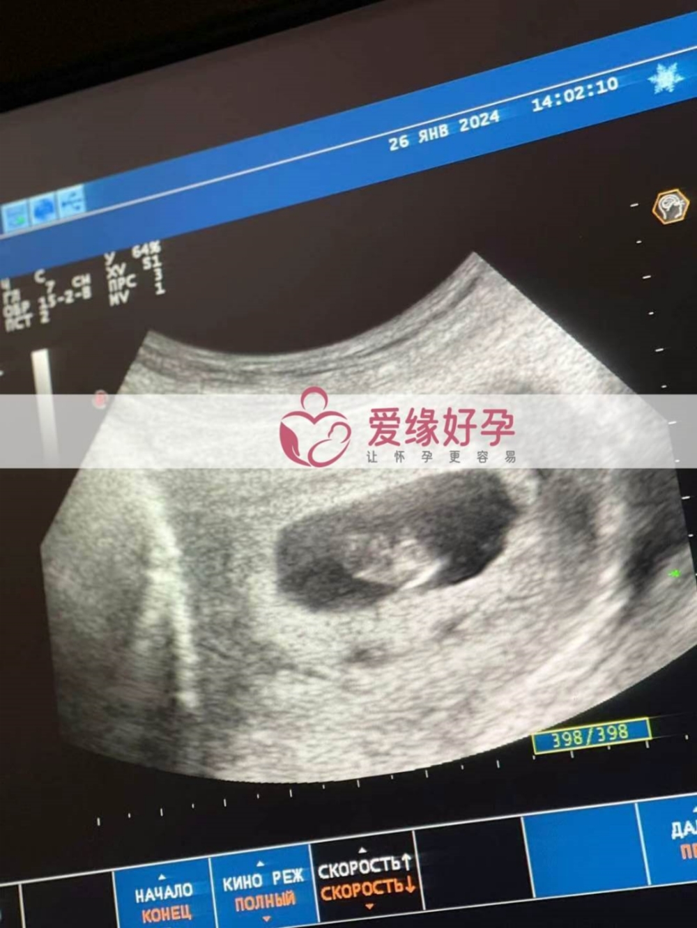 代孕代孕代母7周产检顺利通过