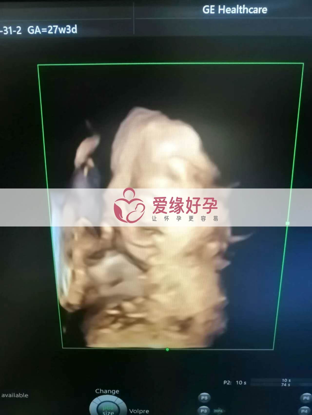代孕代孕代母27周产检顺利通过