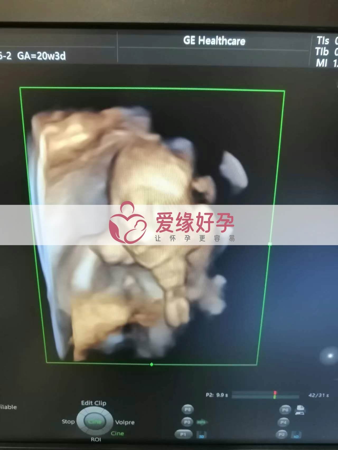 代孕代孕代母20周产检顺利通过