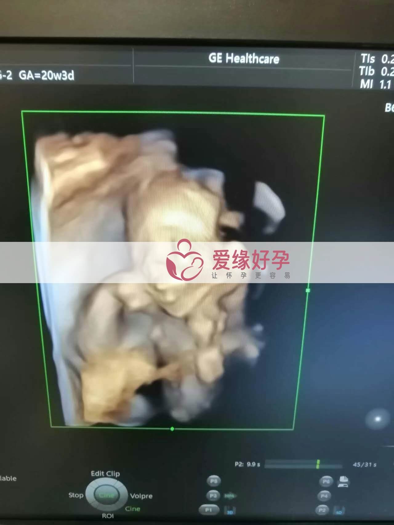 代孕代孕代母20周产检顺利通过