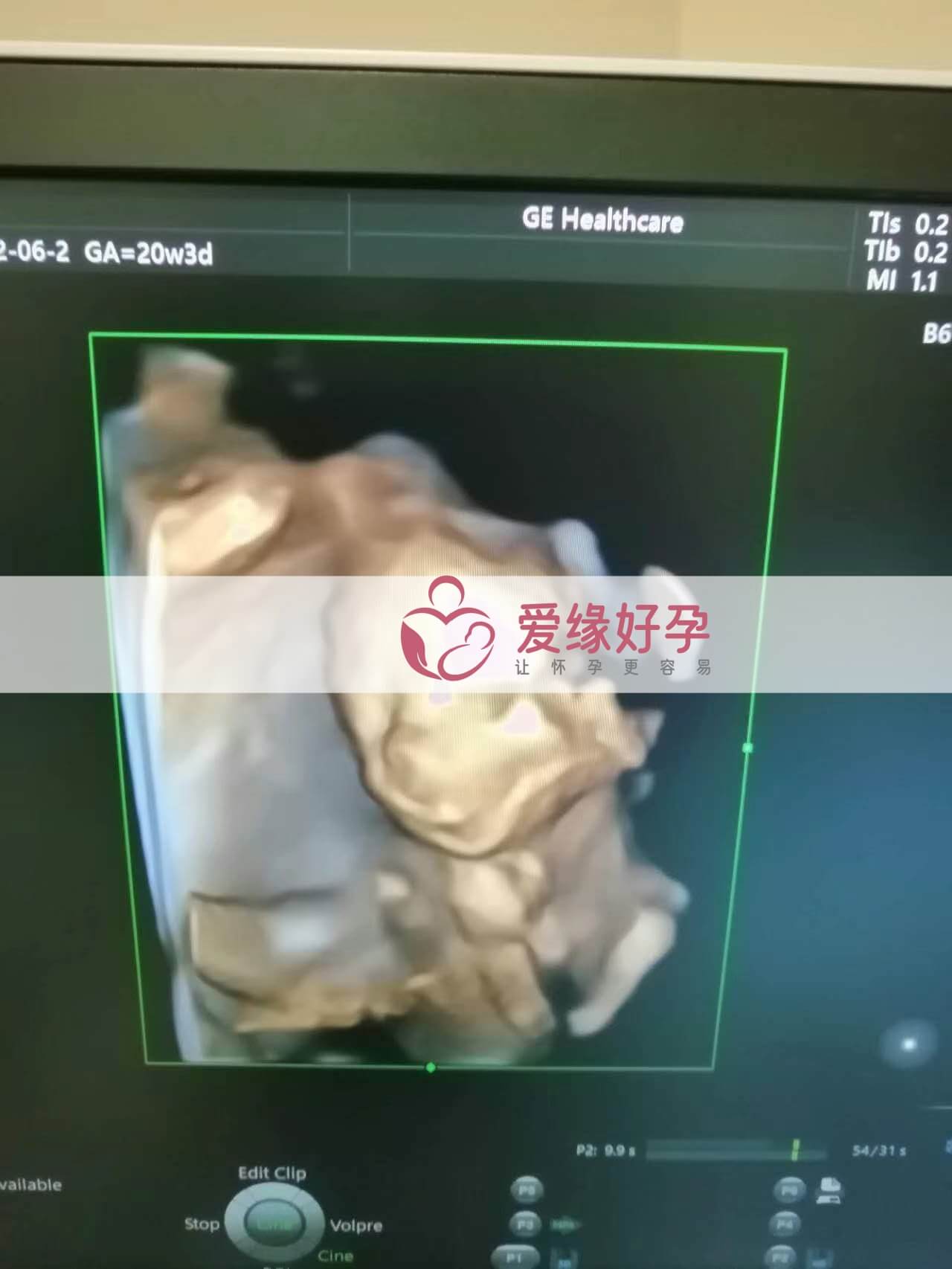 代孕代孕代母20周产检顺利通过